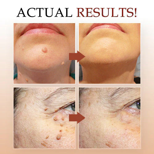 Jaysuing Liquid Wart Remover – Advanced Wart Removal Treatment