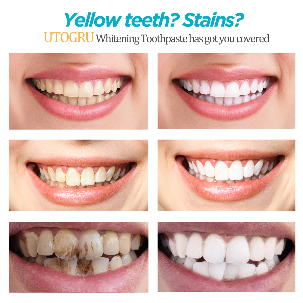UTOGRU Nicotinamide Whitening Toothpaste Get Whiter Teeth in Just 7 Days — Without Expensive Dental Treatments
