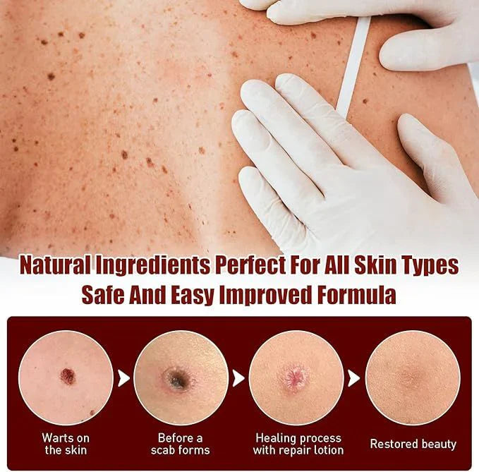 Jaysuing Liquid Wart Remover – Advanced Wart Removal Treatment
