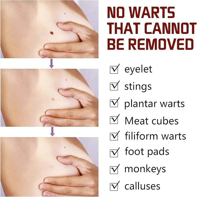 Jaysuing Liquid Wart Remover – Advanced Wart Removal Treatment