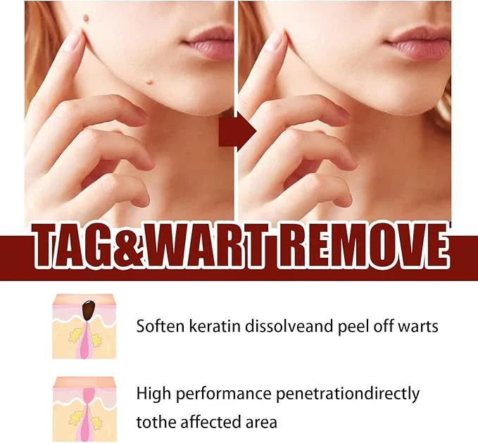 Jaysuing Liquid Wart Remover – Advanced Wart Removal Treatment